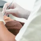 むし歯